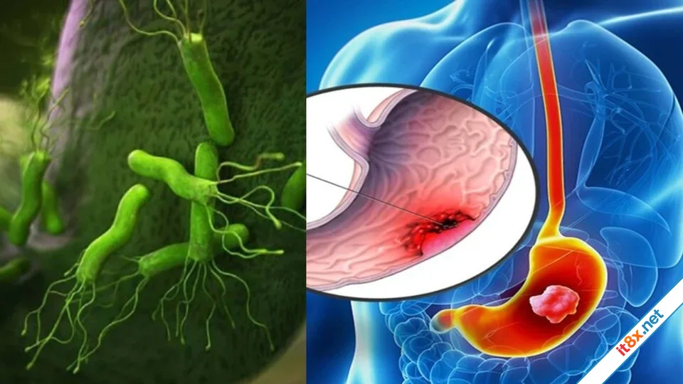 Mẹo kiểm soát bệnh viêm dạ dày tại nhà hiệu quả