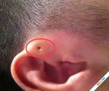Mẹ phát hiện gần tai con xuất hiện một lỗ sâu khác thường liền tò mò bóp thử, không ngờ bác sĩ yêu cầu phẫu thuật ngay