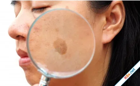 Đốm đồi mồi: Dấu hiệu lão hóa lành tính hay "mầm mống" ung thư da?