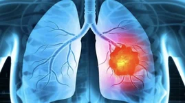 Năm dấu hiệu cảnh báo ung thư phổi cần đi khám ngay